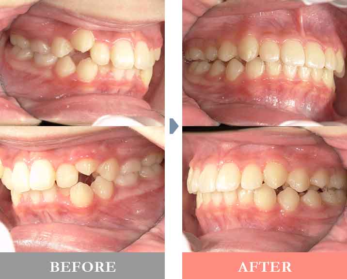 前歯部の叢生と歯の萌出状態の確認