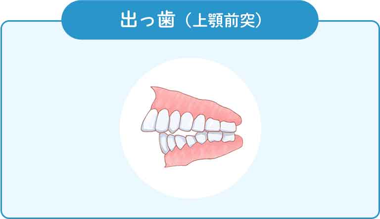 出っ歯(上顎前突)