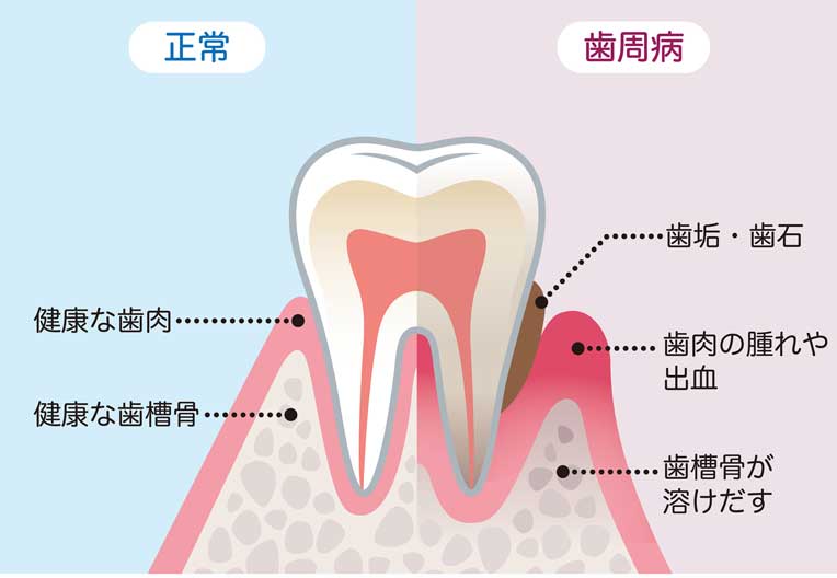 歯周病治療 武蔵小杉まつ歯科クリニック